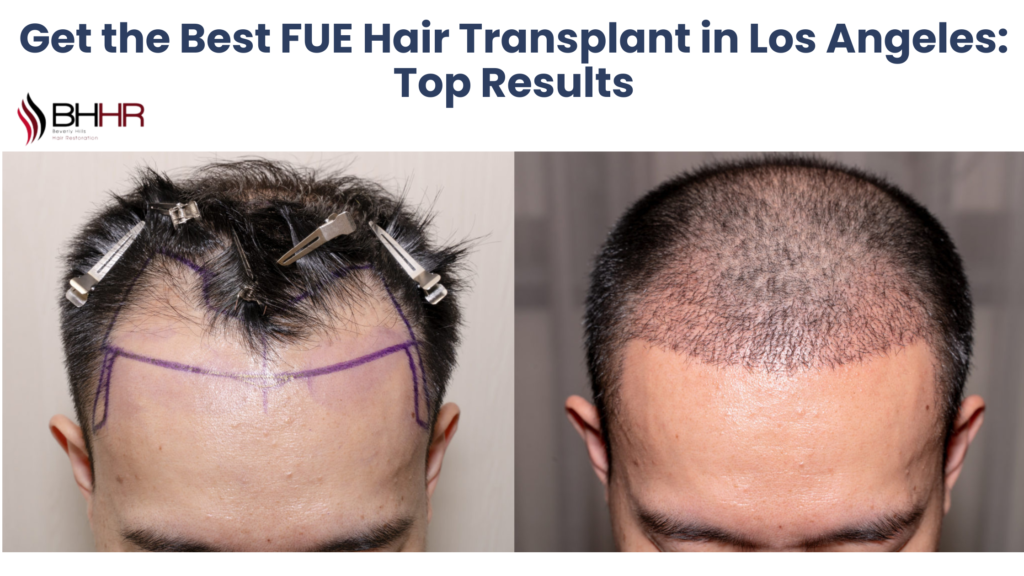 best fue hair transplant los angeles